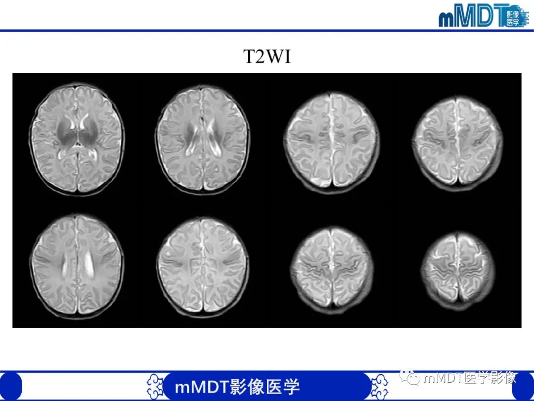 影像PPT - 【PPT】新生儿HIE影像学表现-35 影像PPT - 【PPT】新生儿HIE影像学表现-35