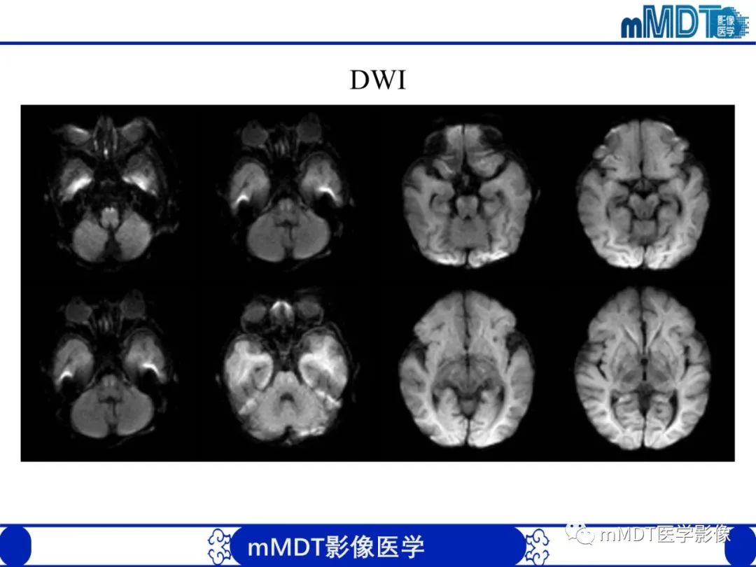 影像PPT - 【PPT】新生儿HIE影像学表现-36 影像PPT - 【PPT】新生儿HIE影像学表现-36