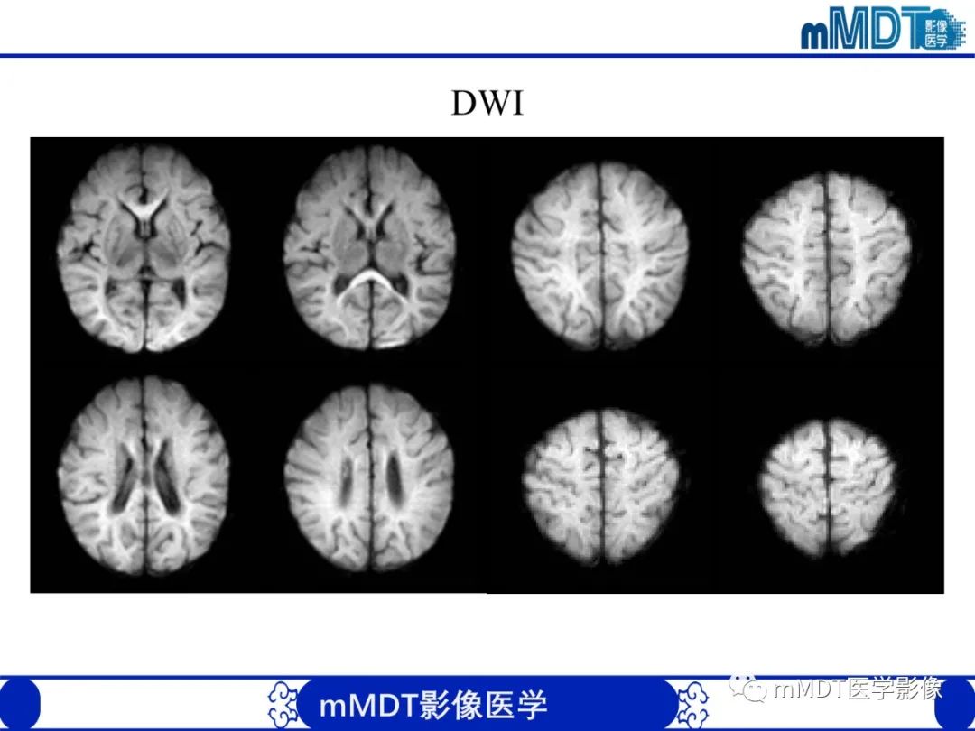 影像PPT - 【PPT】新生儿HIE影像学表现-37 影像PPT - 【PPT】新生儿HIE影像学表现-37