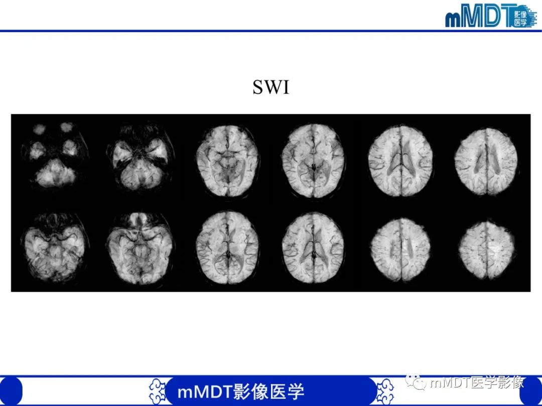 影像PPT - 【PPT】新生儿HIE影像学表现-38 影像PPT - 【PPT】新生儿HIE影像学表现-38