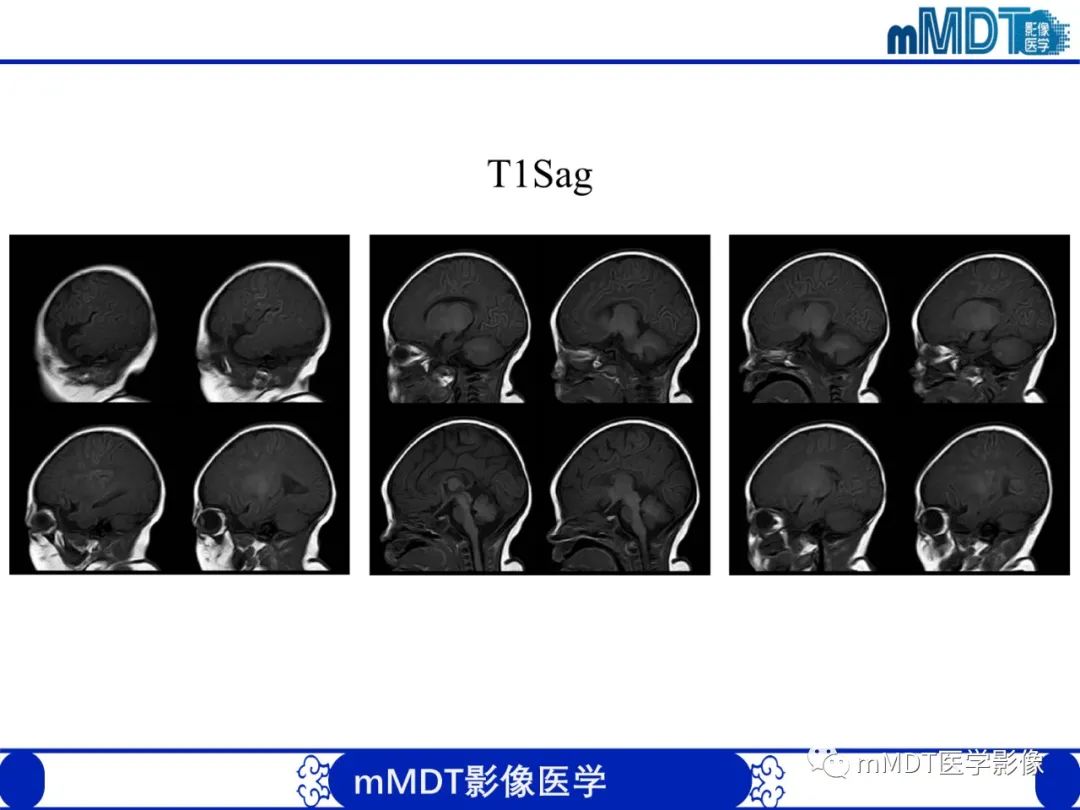 影像PPT - 【PPT】新生儿HIE影像学表现-39 影像PPT - 【PPT】新生儿HIE影像学表现-39
