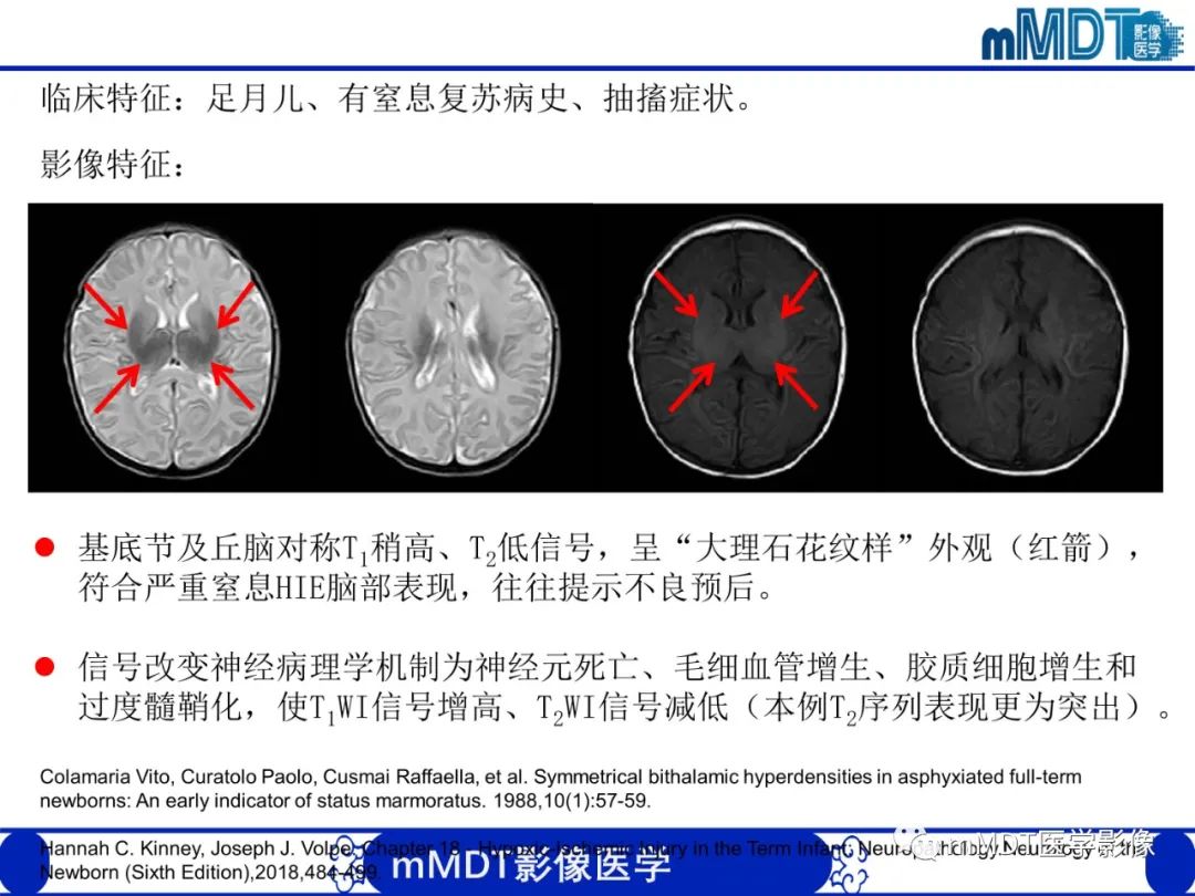影像PPT - 【PPT】新生儿HIE影像学表现-40 影像PPT - 【PPT】新生儿HIE影像学表现-40