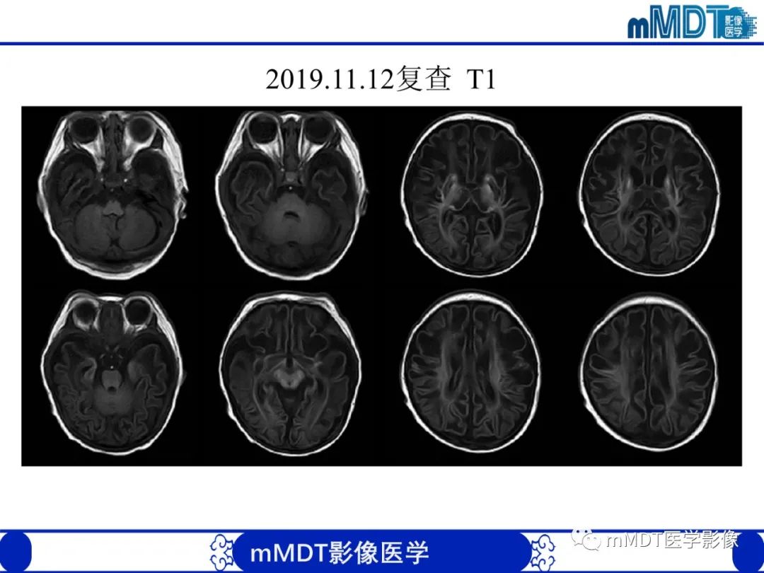 影像PPT - 【PPT】新生儿HIE影像学表现-42 影像PPT - 【PPT】新生儿HIE影像学表现-42