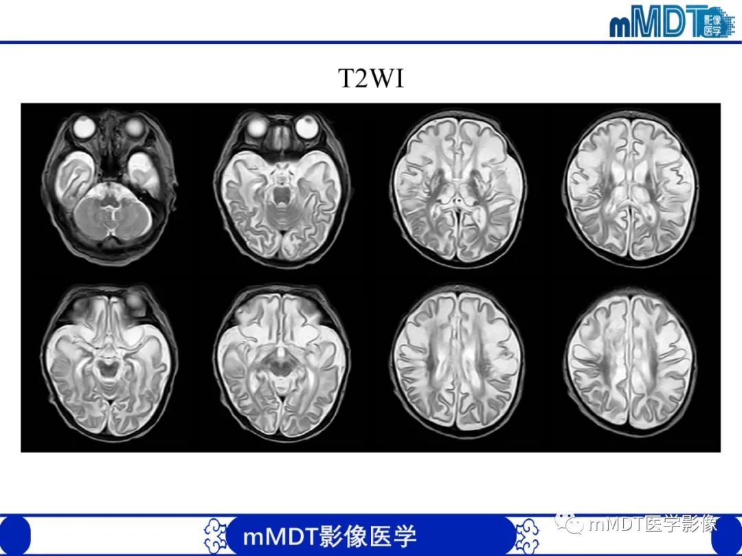 影像PPT - 【PPT】新生儿HIE影像学表现-43 影像PPT - 【PPT】新生儿HIE影像学表现-43