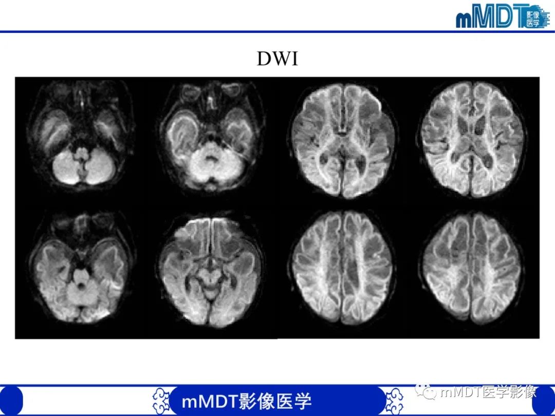 影像PPT - 【PPT】新生儿HIE影像学表现-44 影像PPT - 【PPT】新生儿HIE影像学表现-44
