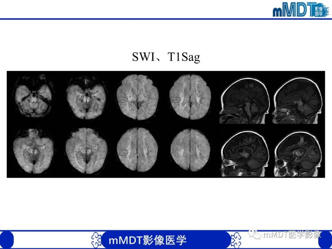 影像PPT - 【PPT】新生儿HIE影像学表现-45 影像PPT - 【PPT】新生儿HIE影像学表现-45