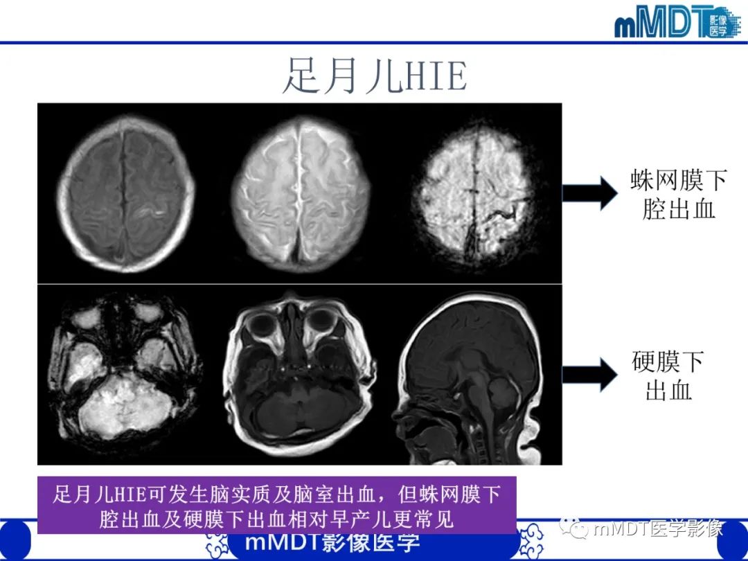 影像PPT - 【PPT】新生儿HIE影像学表现-47 影像PPT - 【PPT】新生儿HIE影像学表现-47