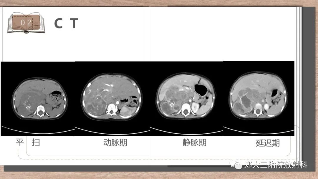 影像PPT - 【病例】神经母细胞瘤1例CT影像鉴别诊断-3