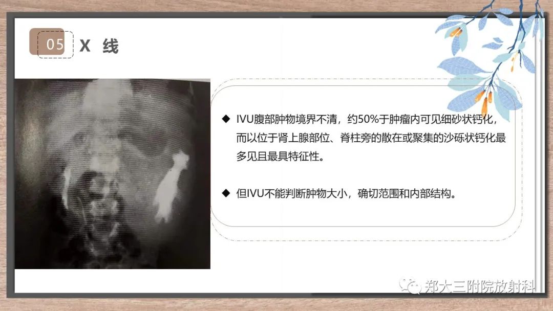影像PPT - 【病例】神经母细胞瘤1例CT影像鉴别诊断-16