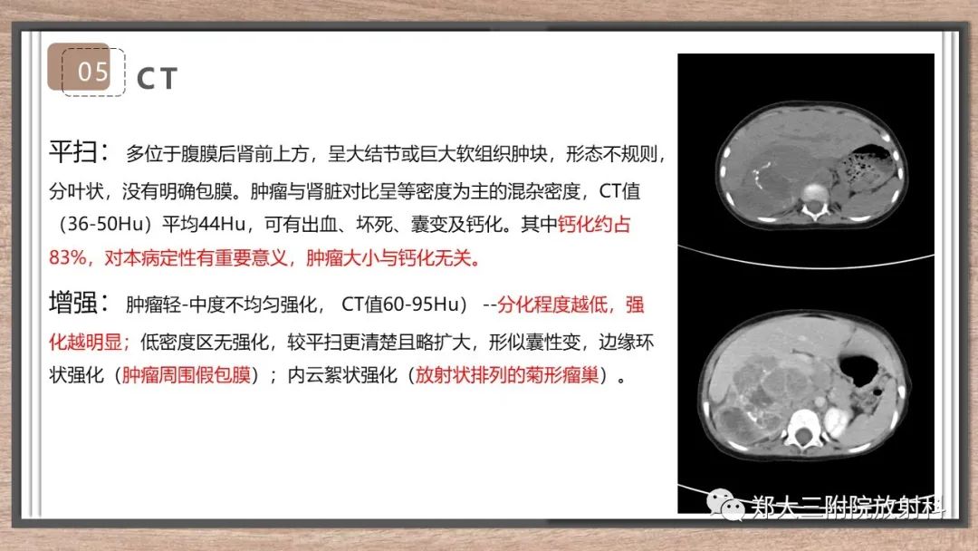 影像PPT - 【病例】神经母细胞瘤1例CT影像鉴别诊断-17