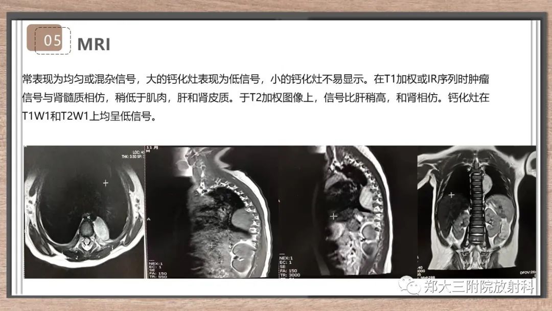 影像PPT - 【病例】神经母细胞瘤1例CT影像鉴别诊断-18