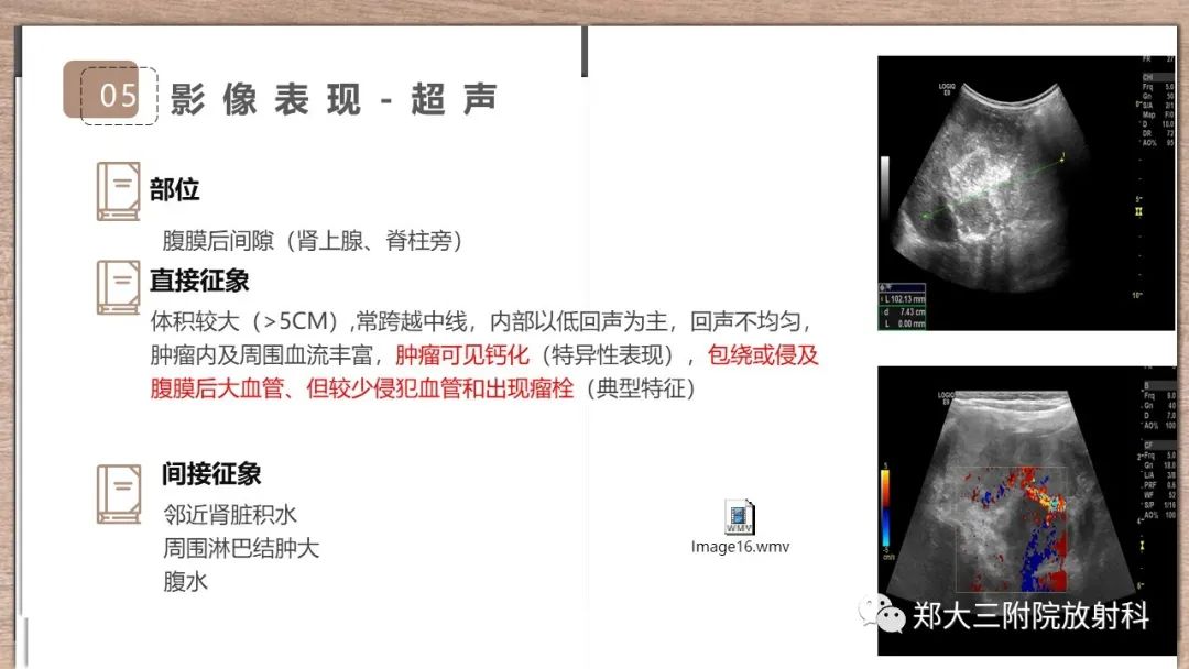 影像PPT - 【病例】神经母细胞瘤1例CT影像鉴别诊断-19