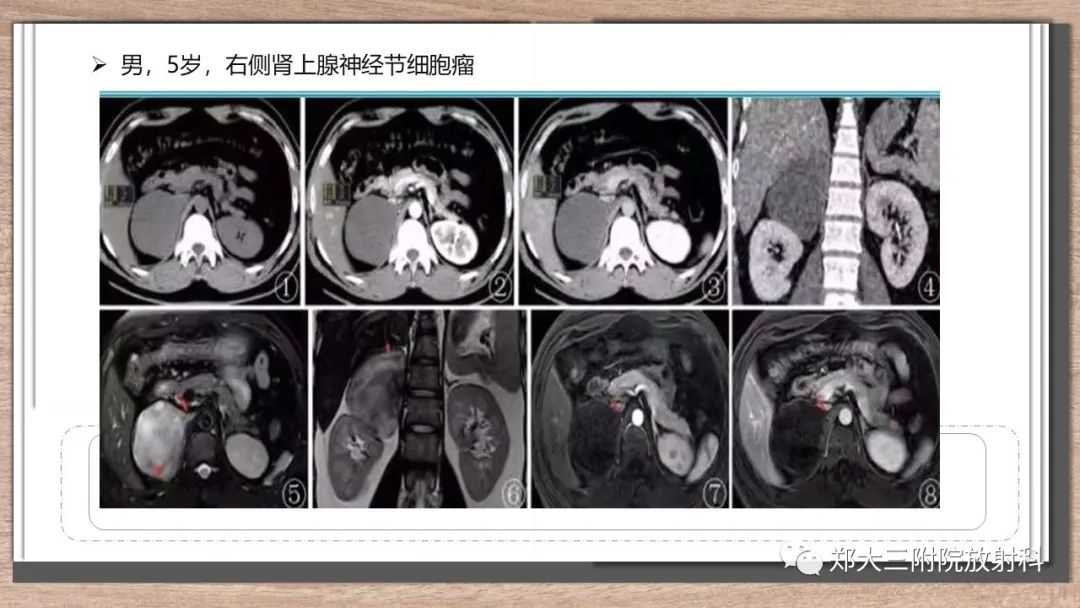 影像PPT - 【病例】神经母细胞瘤1例CT影像鉴别诊断-23