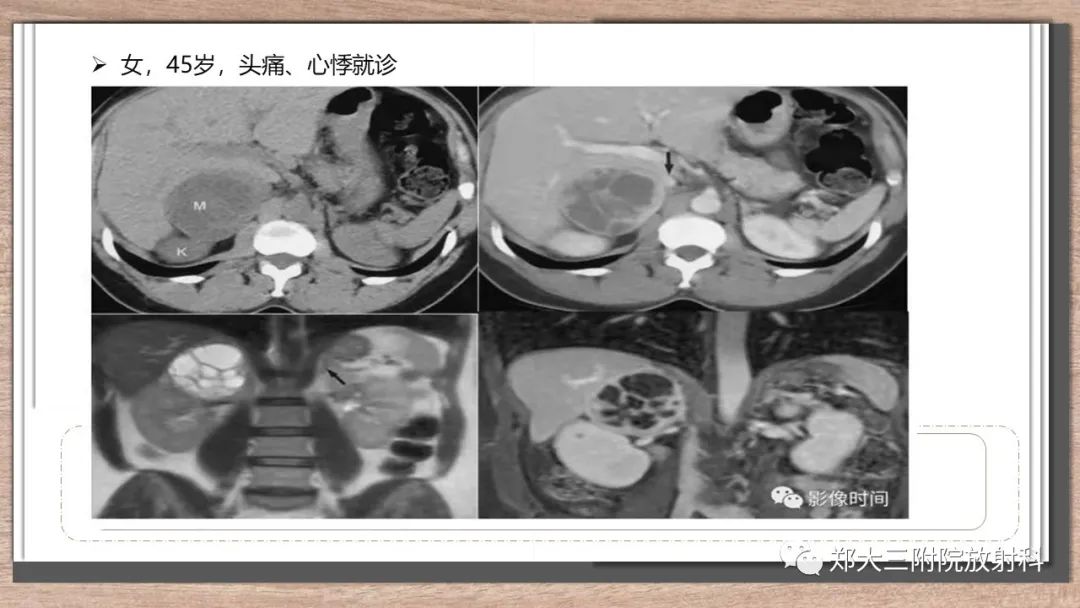 影像PPT - 【病例】神经母细胞瘤1例CT影像鉴别诊断-25