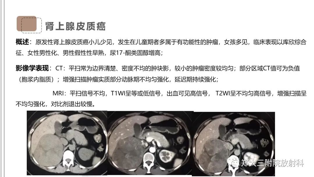 影像PPT - 【病例】神经母细胞瘤1例CT影像鉴别诊断-26