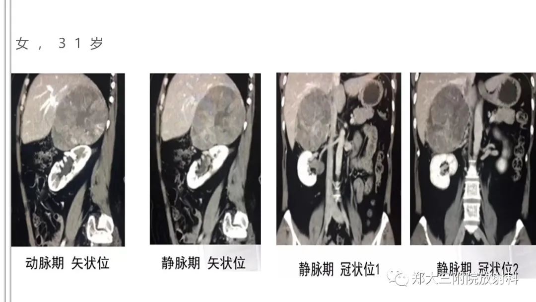 影像PPT - 【病例】神经母细胞瘤1例CT影像鉴别诊断-27