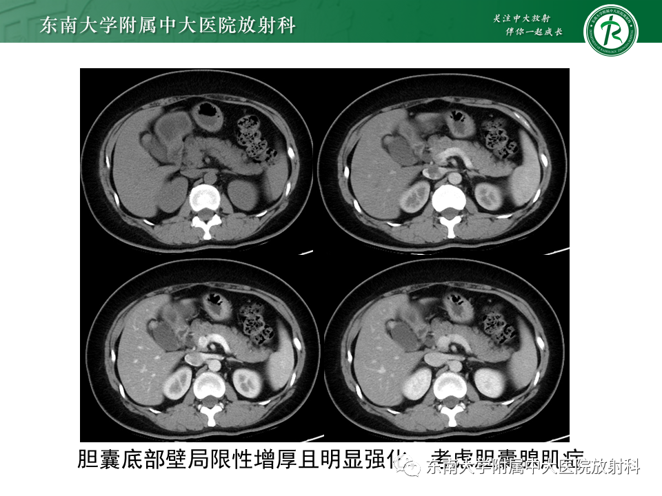 影像PPT - 【病例】胆囊腺肌症1例CT影像诊断-2
