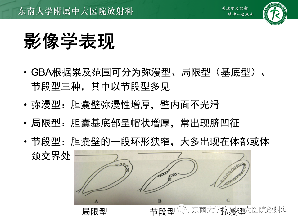 影像PPT - 【病例】胆囊腺肌症1例CT影像诊断-6