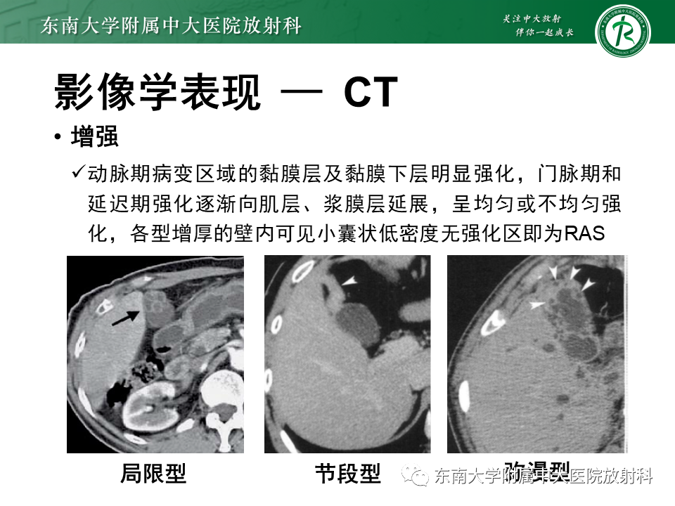 影像PPT - 【病例】胆囊腺肌症1例CT影像诊断-7