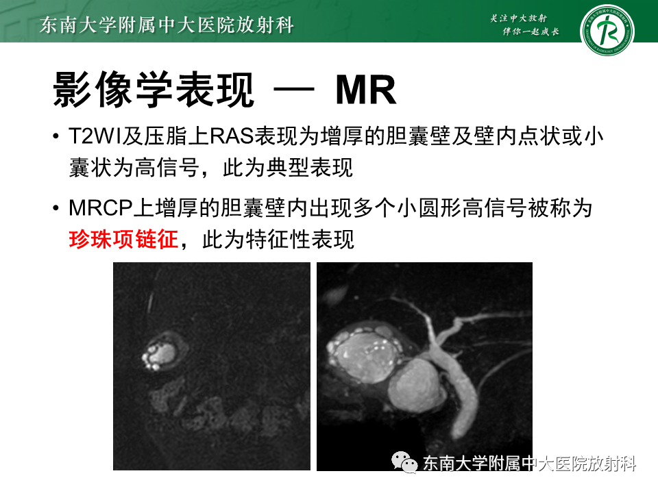影像PPT - 【病例】胆囊腺肌症1例CT影像诊断-8