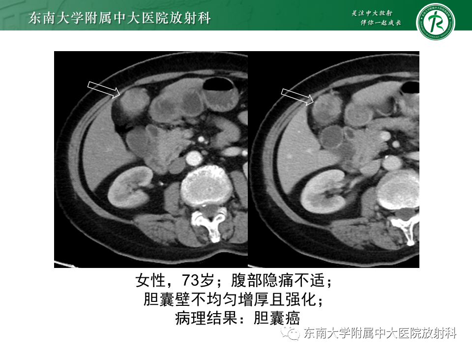 影像PPT - 【病例】胆囊腺肌症1例CT影像诊断-11