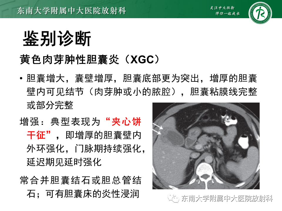 影像PPT - 【病例】胆囊腺肌症1例CT影像诊断-13