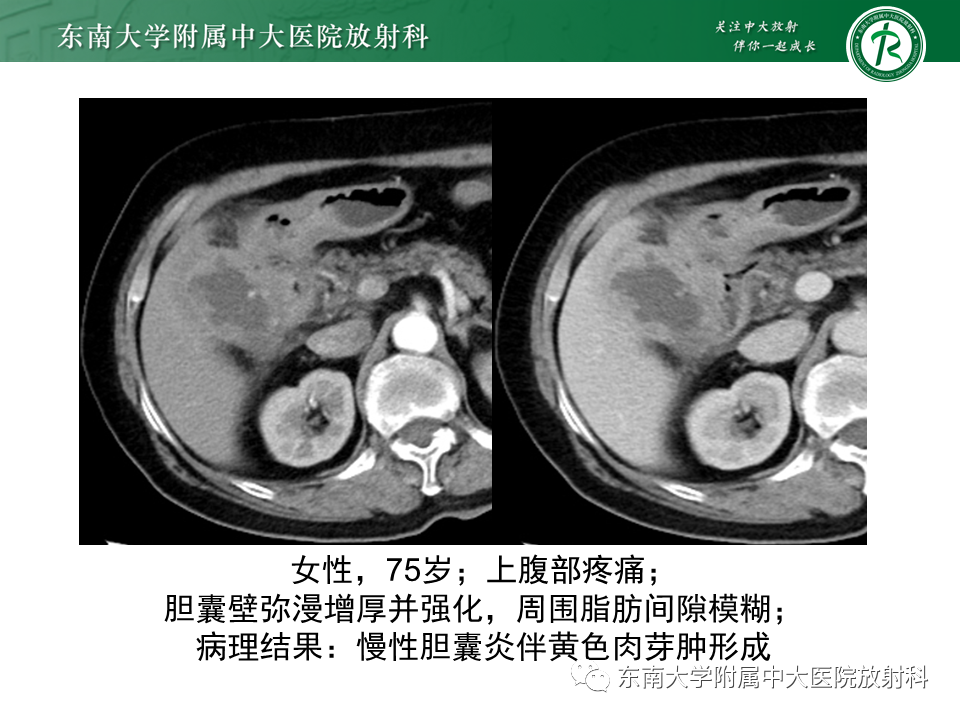 影像PPT - 【病例】胆囊腺肌症1例CT影像诊断-14