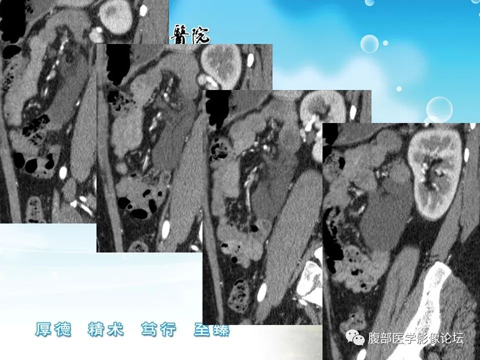 影像PPT - 【病例】肠系膜淋巴管(脂肪)瘤1例CT影像-8