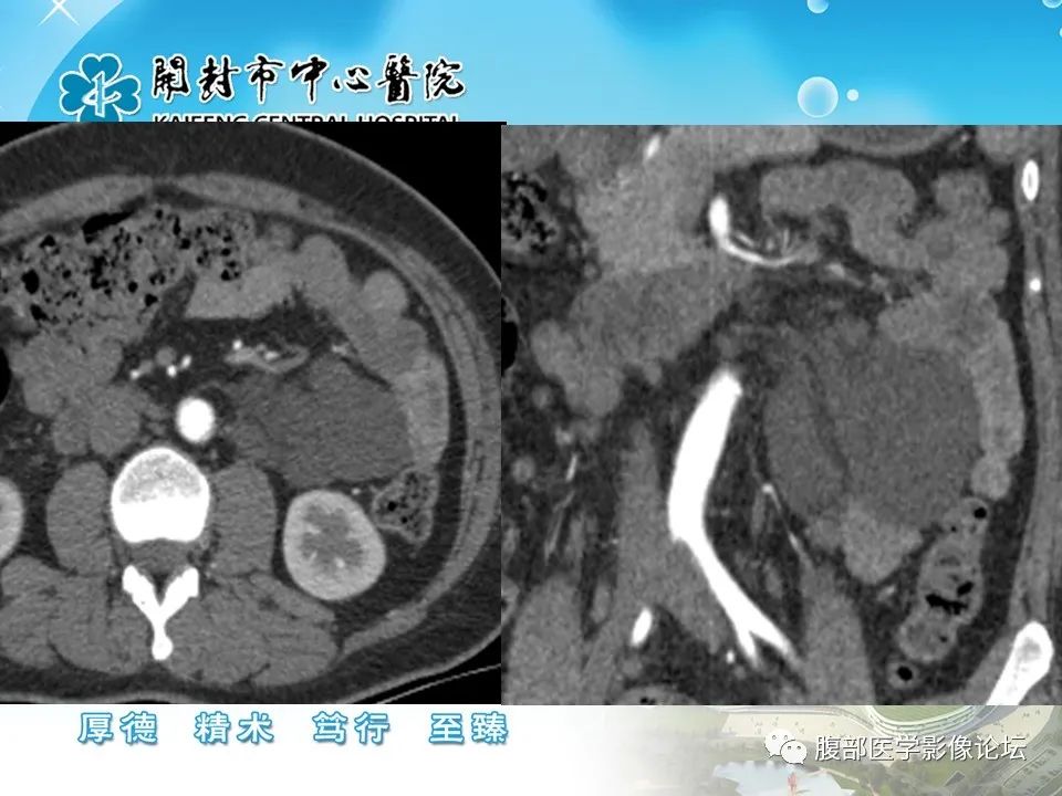 影像PPT - 【病例】肠系膜淋巴管(脂肪)瘤1例CT影像-10