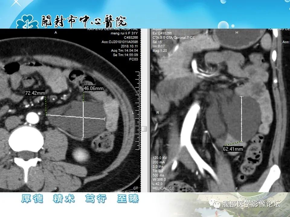 影像PPT - 【病例】肠系膜淋巴管(脂肪)瘤1例CT影像-11