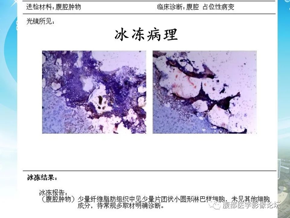 影像PPT - 【病例】肠系膜淋巴管(脂肪)瘤1例CT影像-19