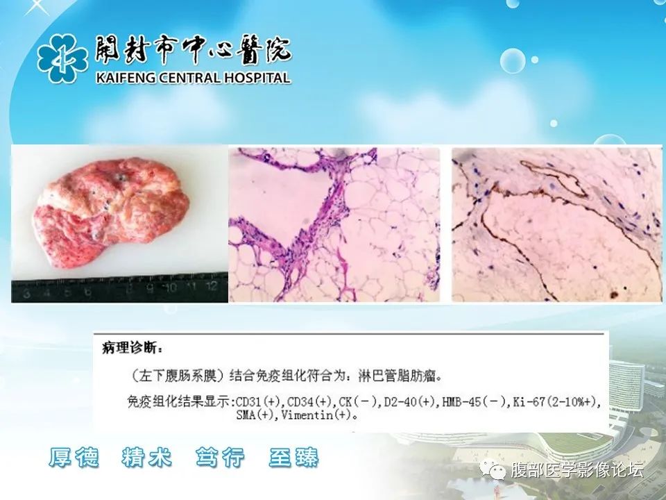影像PPT - 【病例】肠系膜淋巴管(脂肪)瘤1例CT影像-20