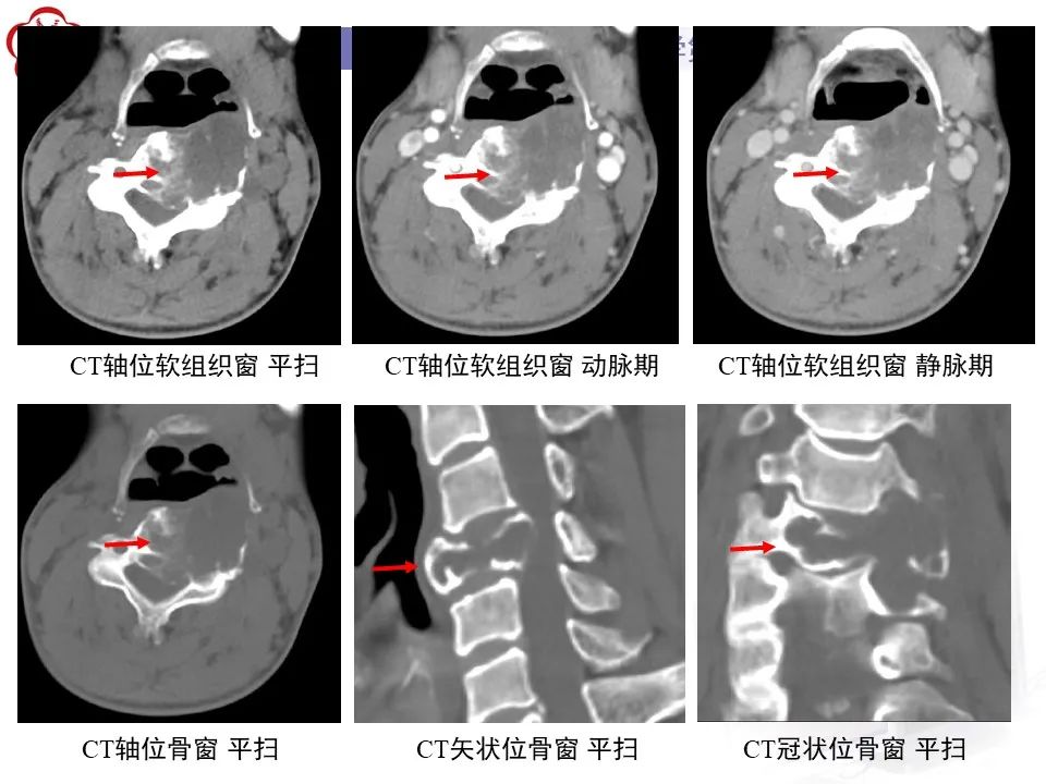 影像PPT - 【PPT】脊柱骨内神经鞘瘤的影像-3