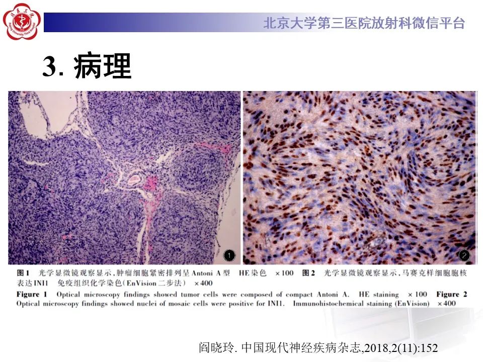 影像PPT - 【PPT】脊柱骨内神经鞘瘤的影像-17