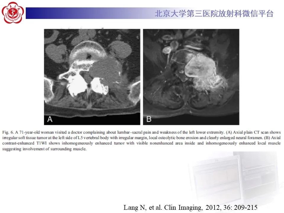 影像PPT - 【PPT】脊柱骨内神经鞘瘤的影像-32