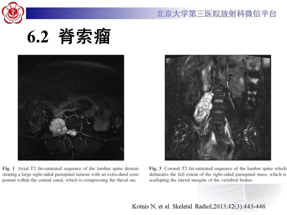 影像PPT - 【PPT】脊柱骨内神经鞘瘤的影像-34