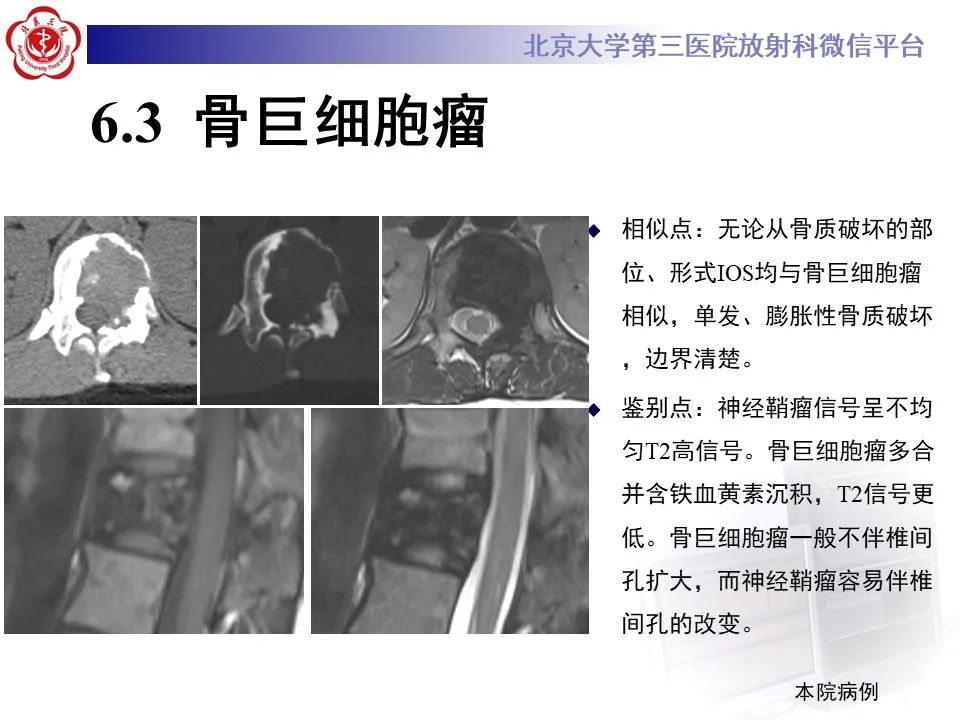 影像PPT - 【PPT】脊柱骨内神经鞘瘤的影像-35