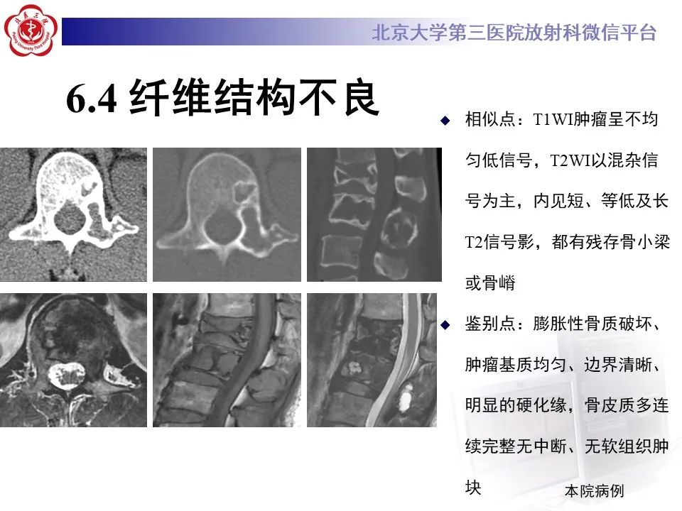 影像PPT - 【PPT】脊柱骨内神经鞘瘤的影像-36