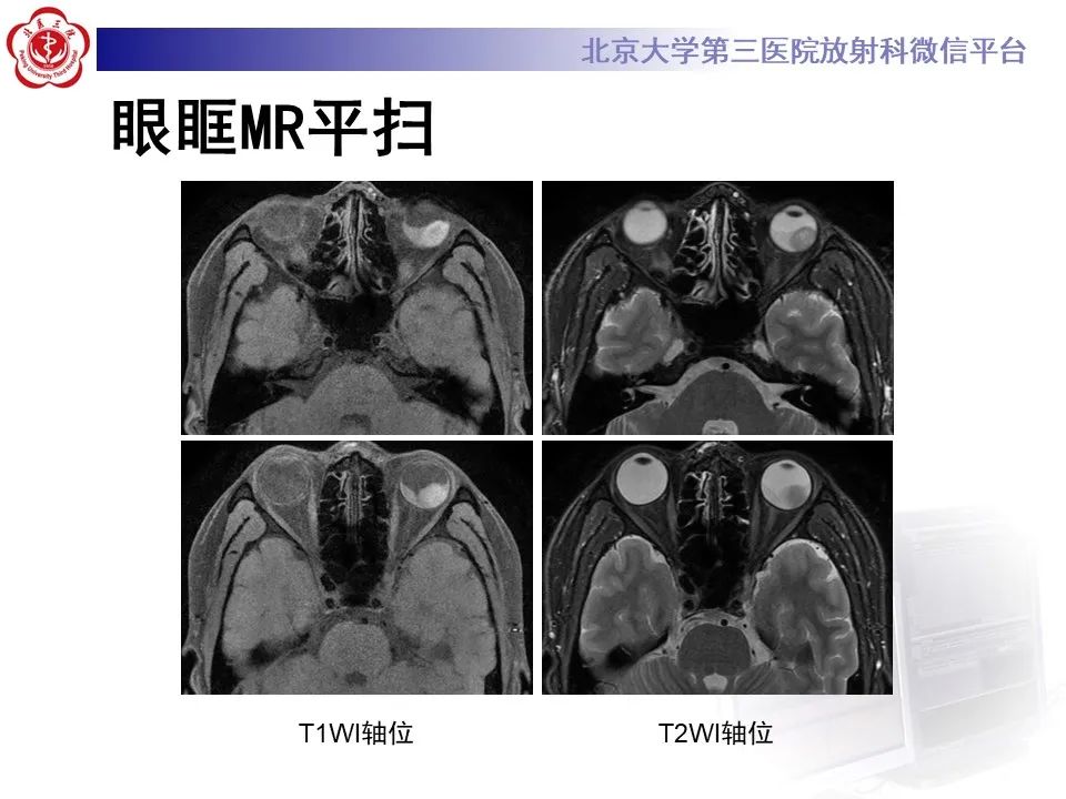 影像PPT - 【PPT】脉络膜黑色素瘤的影像-3
