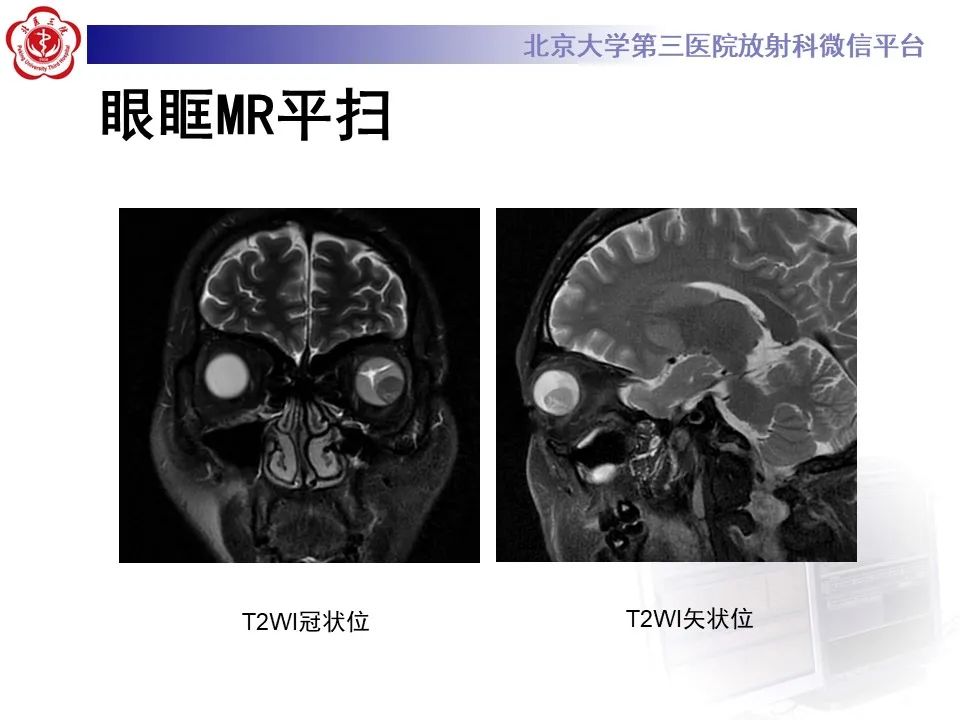 影像PPT - 【PPT】脉络膜黑色素瘤的影像-4