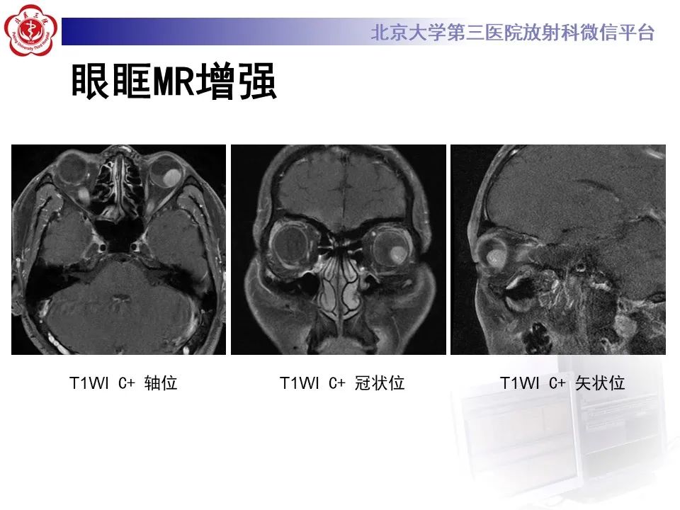 影像PPT - 【PPT】脉络膜黑色素瘤的影像-5