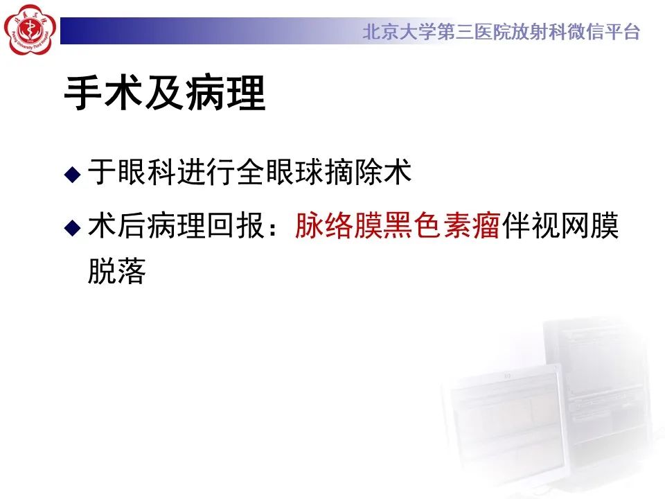 影像PPT - 【PPT】脉络膜黑色素瘤的影像-8