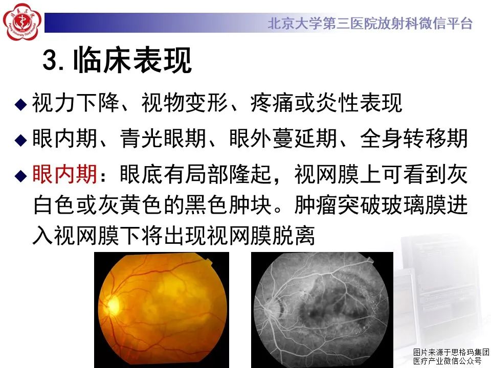 影像PPT - 【PPT】脉络膜黑色素瘤的影像-12