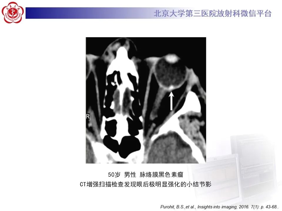 影像PPT - 【PPT】脉络膜黑色素瘤的影像-16