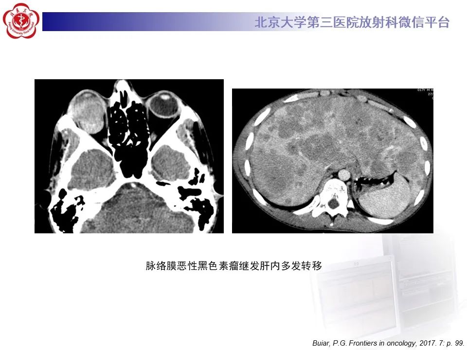 影像PPT - 【PPT】脉络膜黑色素瘤的影像-17