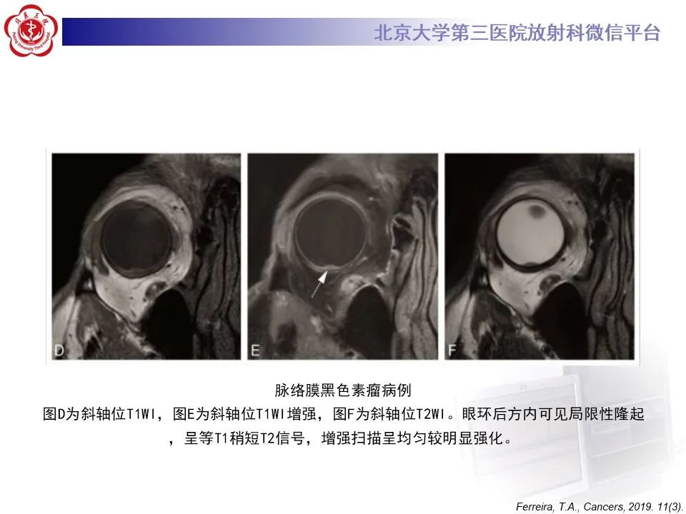 影像PPT - 【PPT】脉络膜黑色素瘤的影像-19