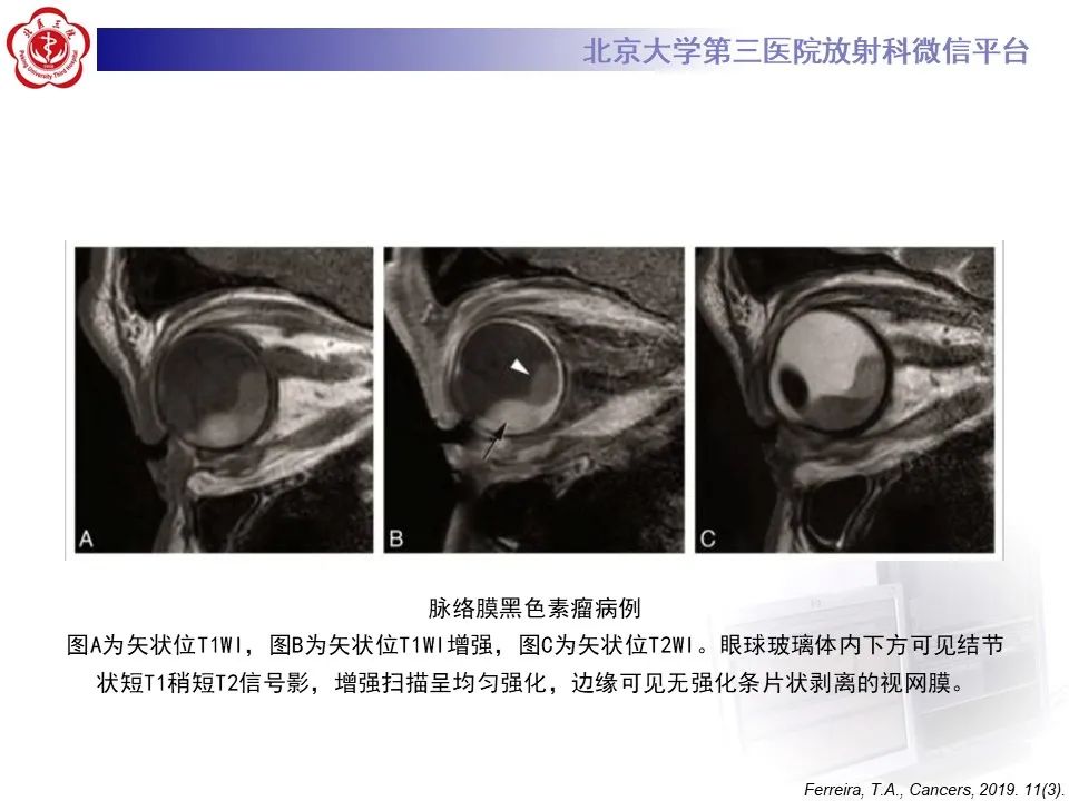 影像PPT - 【PPT】脉络膜黑色素瘤的影像-20