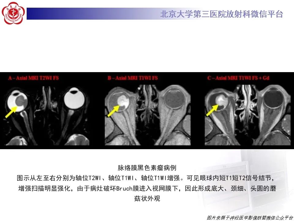影像PPT - 【PPT】脉络膜黑色素瘤的影像-21