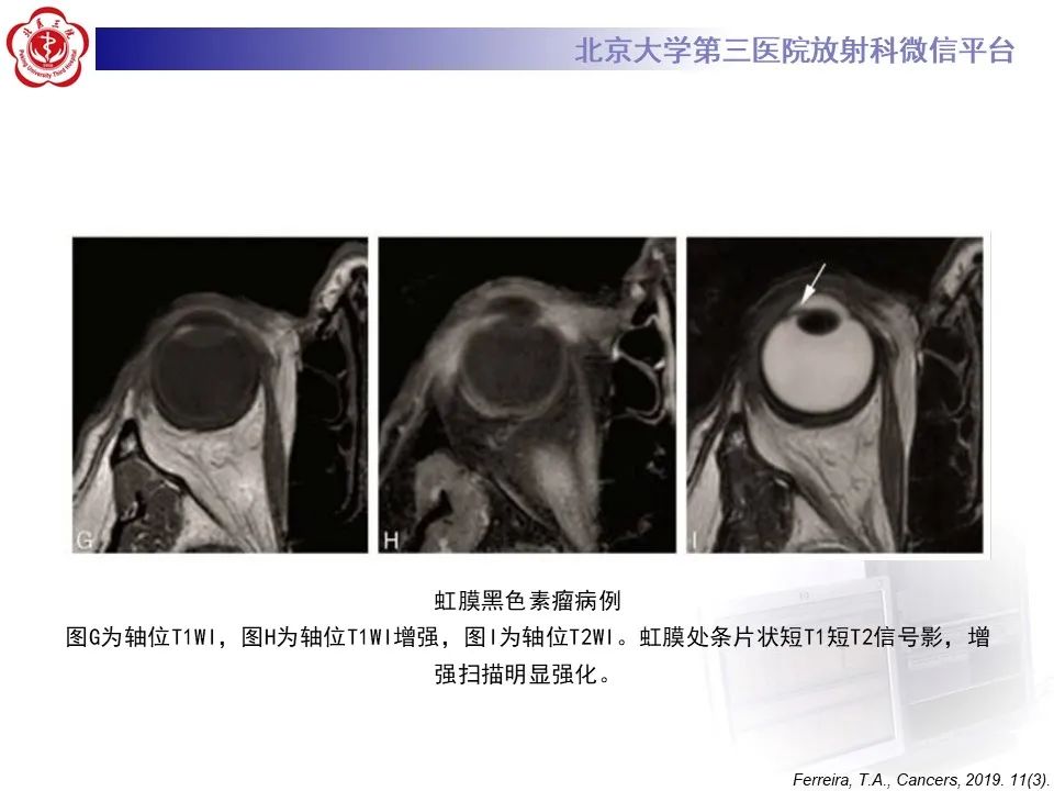 影像PPT - 【PPT】脉络膜黑色素瘤的影像-22