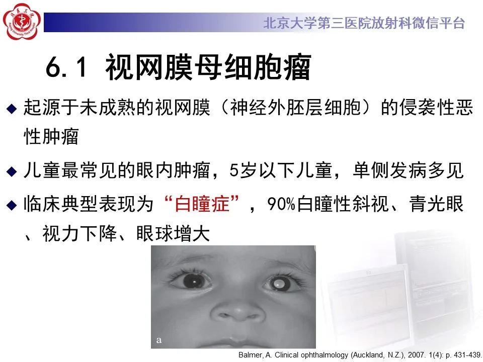影像PPT - 【PPT】脉络膜黑色素瘤的影像-24